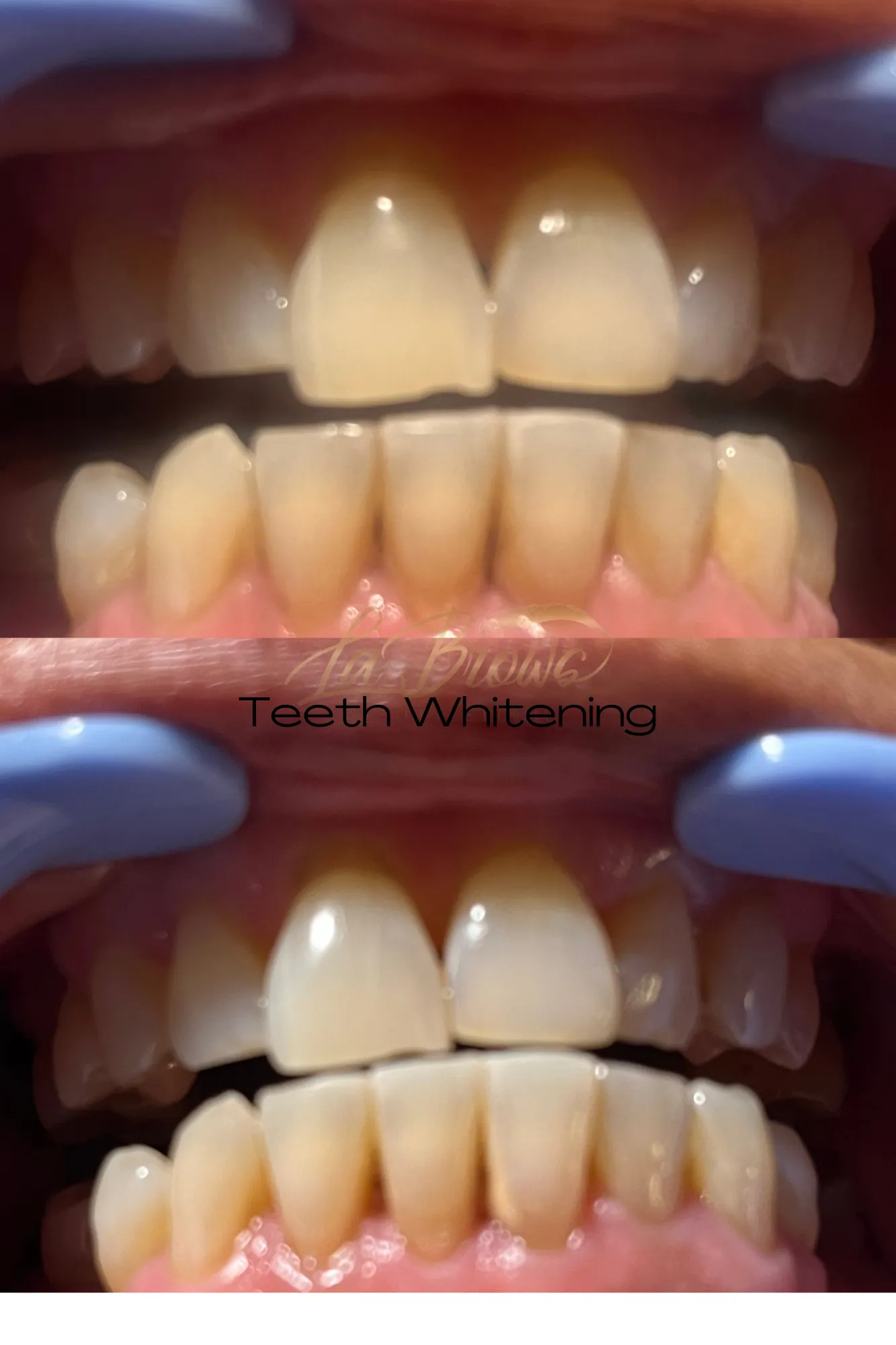 Teeth whitening before and after, LaBrows
