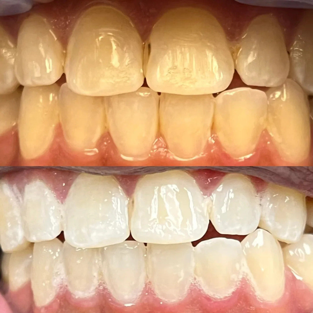Teeth whitening before and after